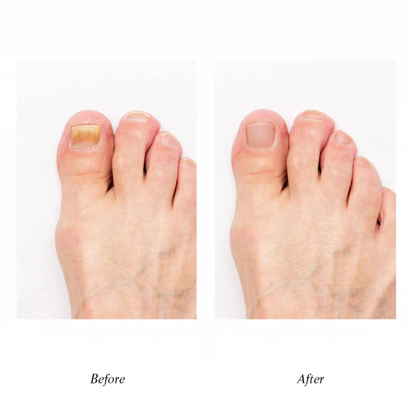 IGIA Callus Remover + Aragan Secret Nail Fungus Repair Oil - 10ml