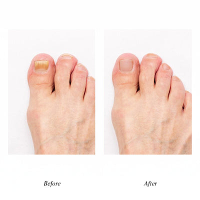 Aragan Secret Nail Fungus Repair Oil - 10ml