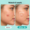 Igia Acne Pimple Patch – Targeted Blemish Patches for Day & Night Use