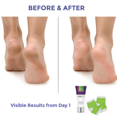 Remedy Health Silky Sox Spa Gel Pedicure Set